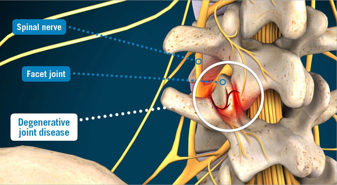 Degenerative Joint Disease USA Spine Care Laser Spine Surgery