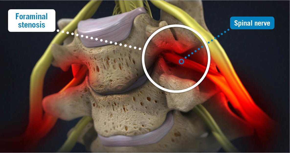 Foraminal Stenosis Usa Spine Care Laser Spine Surgery