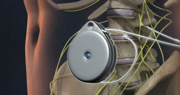 intrathecal pain pump implant
