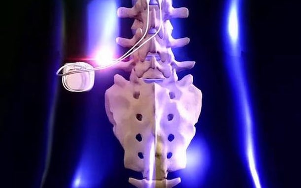 Spinal Cord Stimulator: Uses, Benefits, Side Effects, Precautions