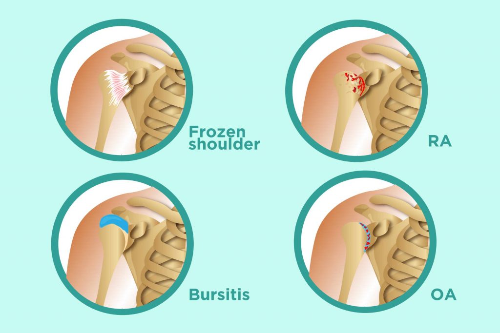 Rheumatoid Arthritis Of The Shoulder USA Spine Care Orthopedics rheumatoid-arthritis-of-the-shoulder-usa-spine-care-orthopedics