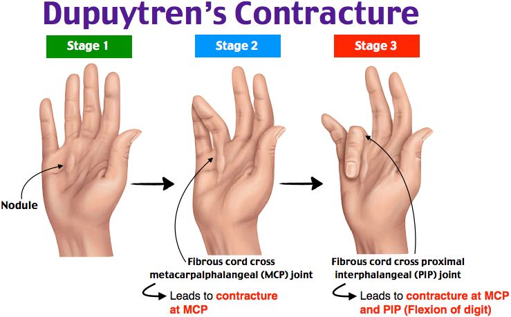duputryn's contracture picture