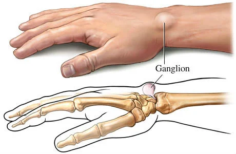 ganglion cyst wrist