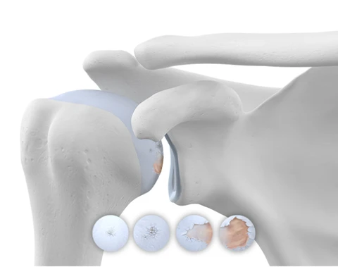 osteoarthritis pain shoulder