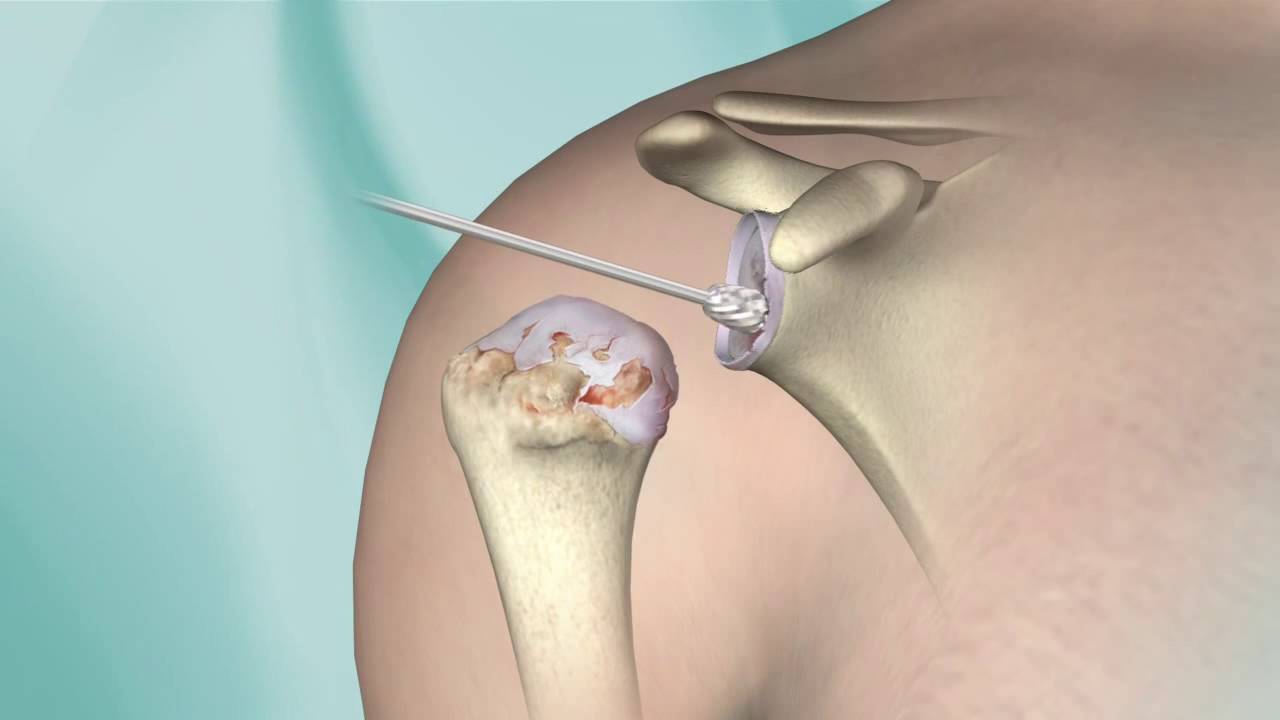partial shoulder replacement hemiarthroplasty