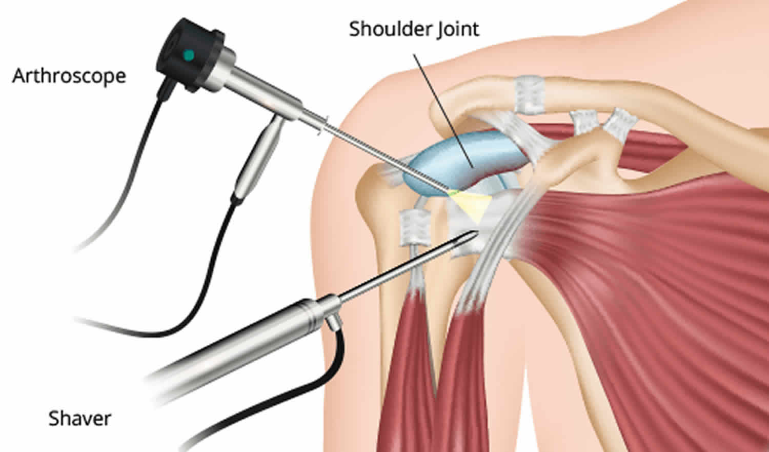 shoulder arthroscopy image