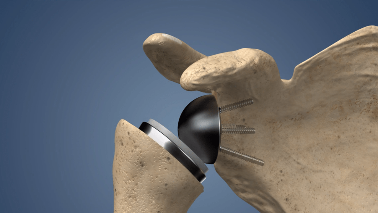 total shoulder replacement arthroplasty