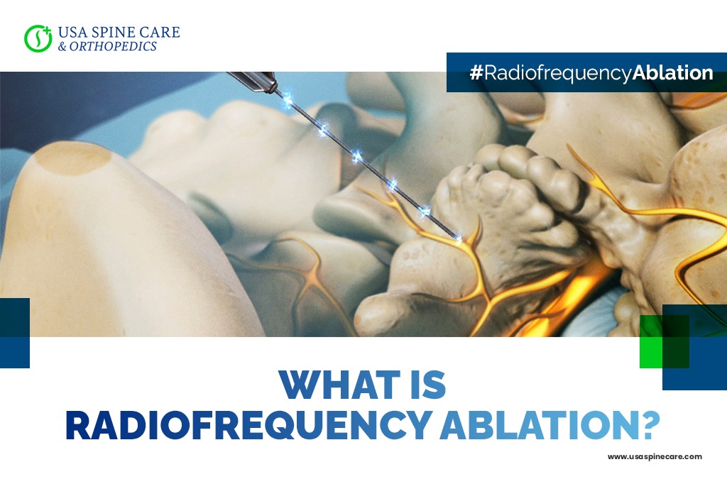 Radiofrequency-ablation