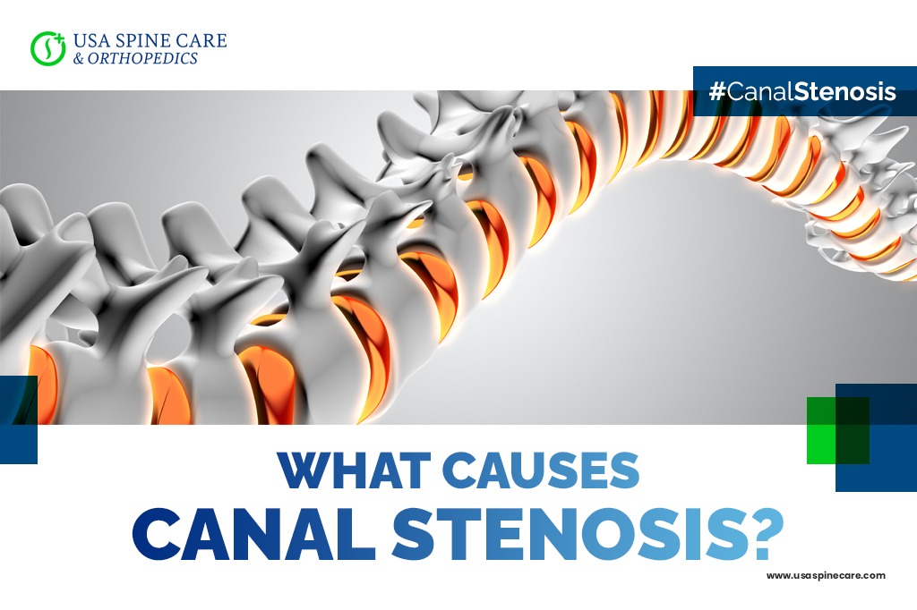 Canal-Stenosis