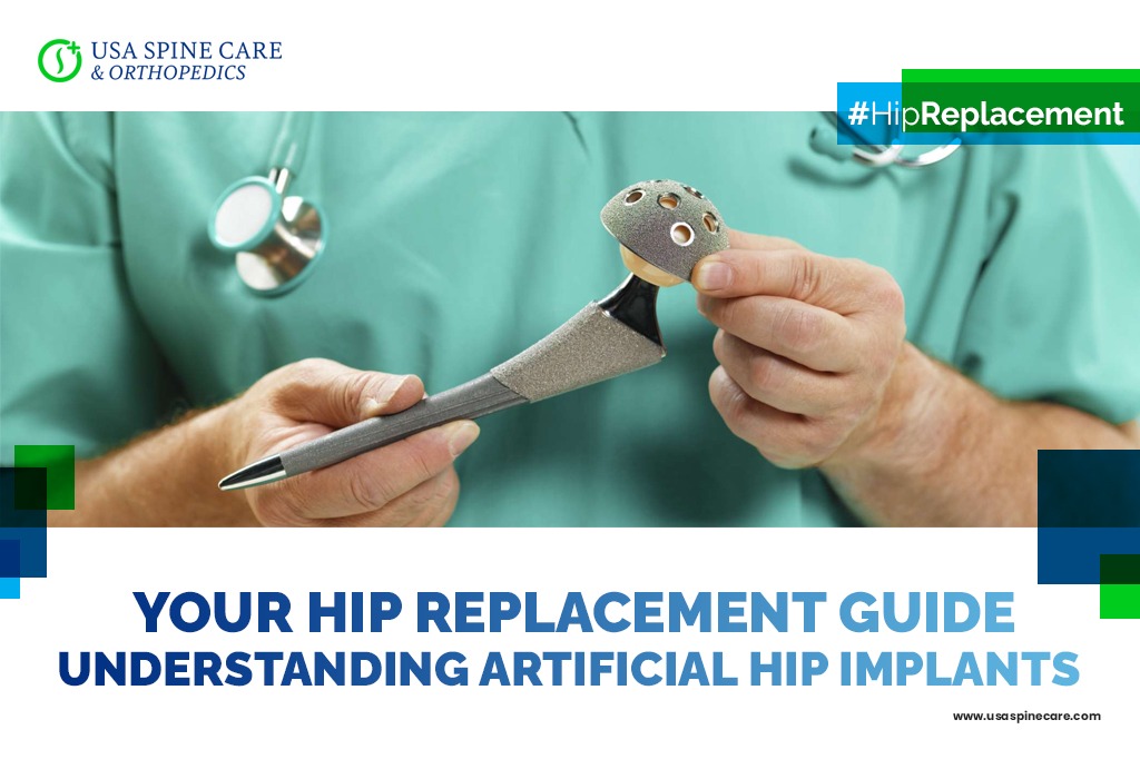 Hip Replacement Guide